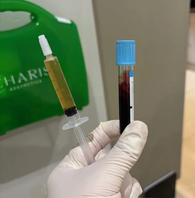 Platelet-rich plasma prepared for treatment